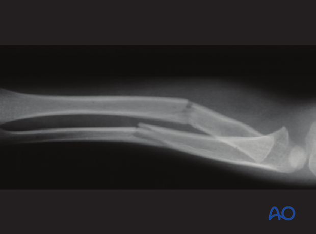 fracture instability and malalignment