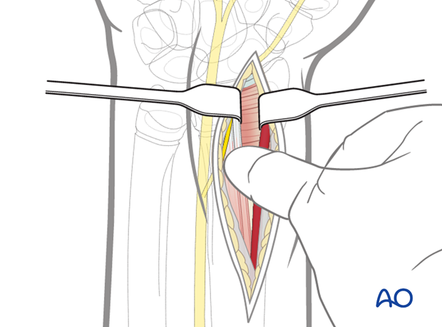 volar anterior approach to the distal radius