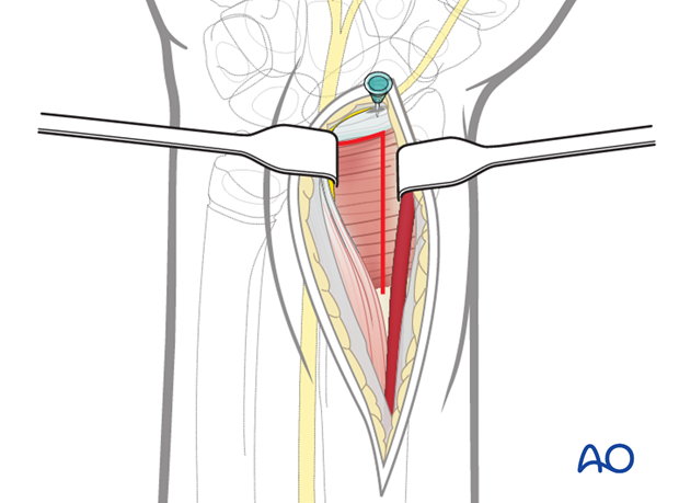 volar anterior approach to the distal radius