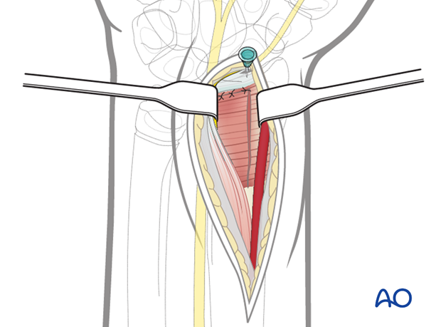 volar anterior approach to the distal radius