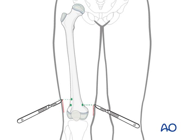 minimally invasive approach