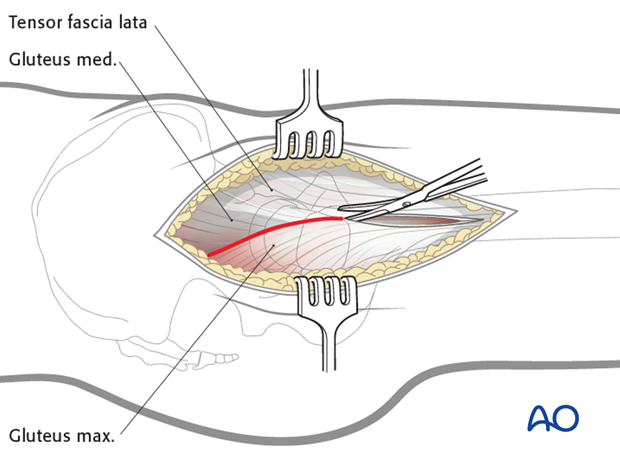 transgluteal approach