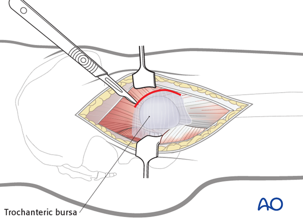 transgluteal approach