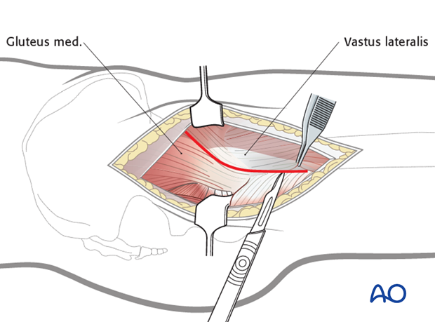 transgluteal approach