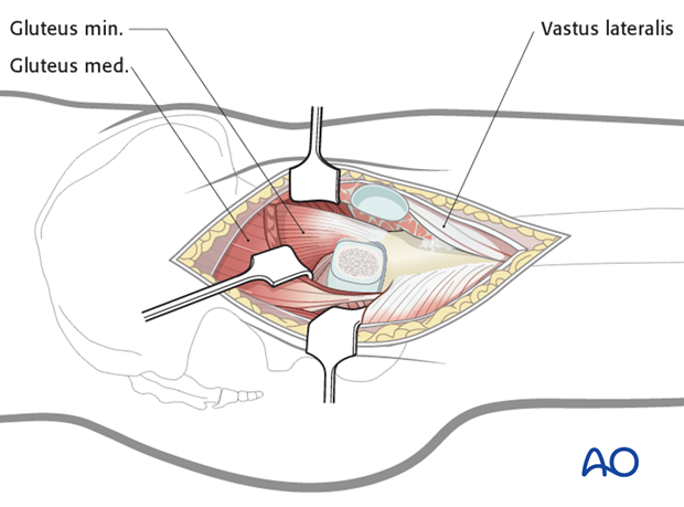 transgluteal approach