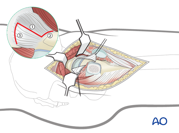 transgluteal approach