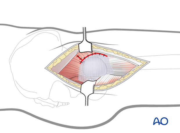 transgluteal approach