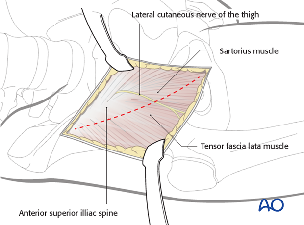 anterior approach