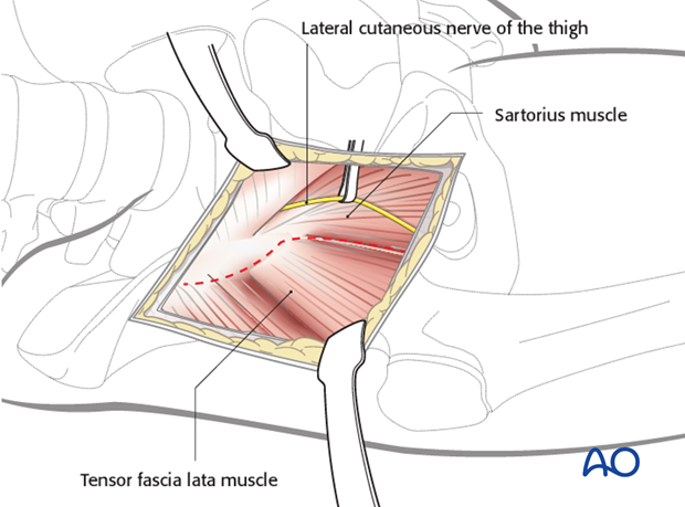 anterior approach