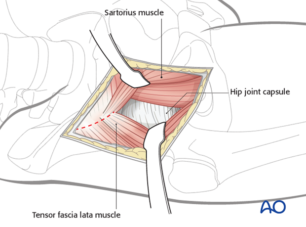 anterior approach