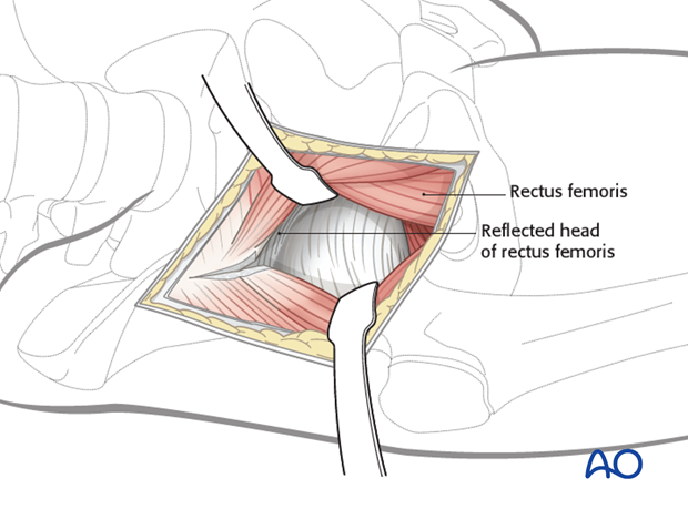 anterior approach