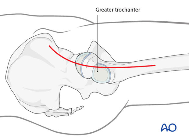 anterolateral approach