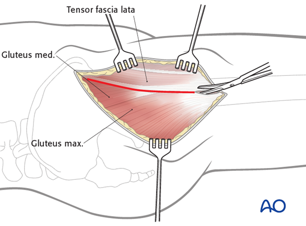 anterolateral approach