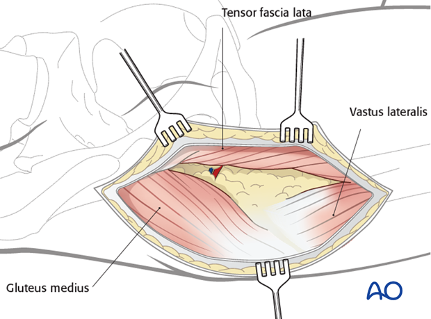 anterolateral approach