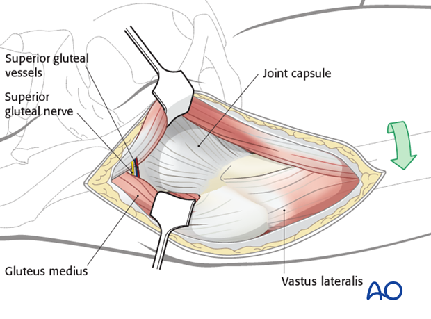 anterolateral approach