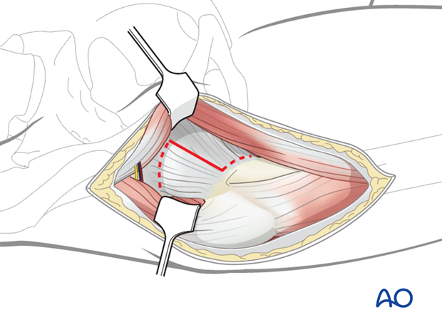 anterolateral approach