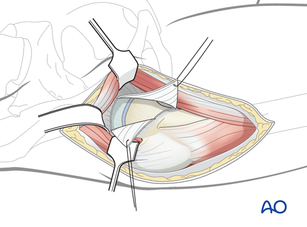 anterolateral approach