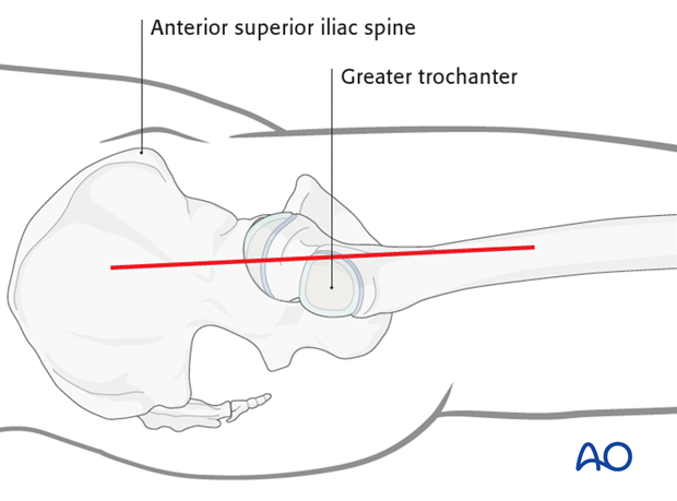 transgluteal approach