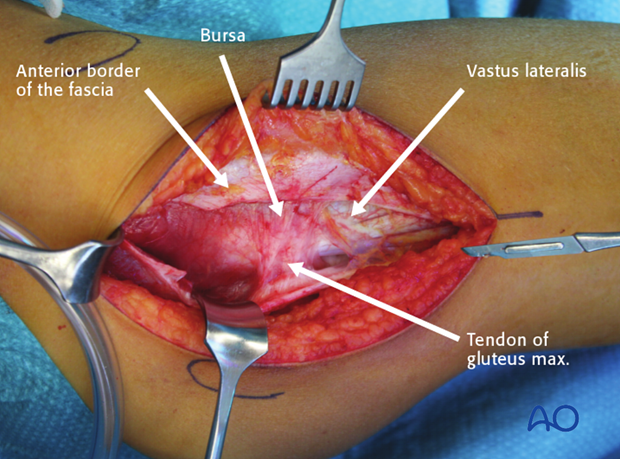 lateral approach via trochanteric flip