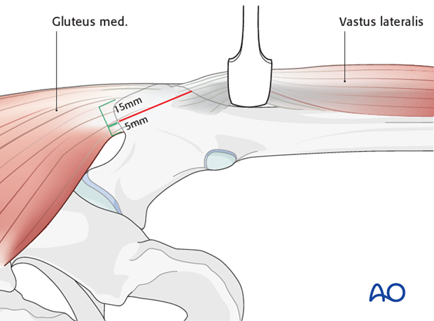 lateral approach via trochanteric flip