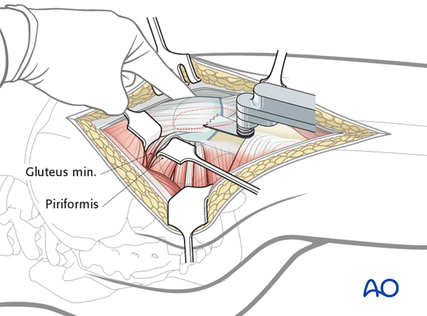 lateral approach via trochanteric flip