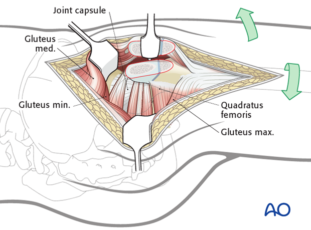 lateral approach via trochanteric flip