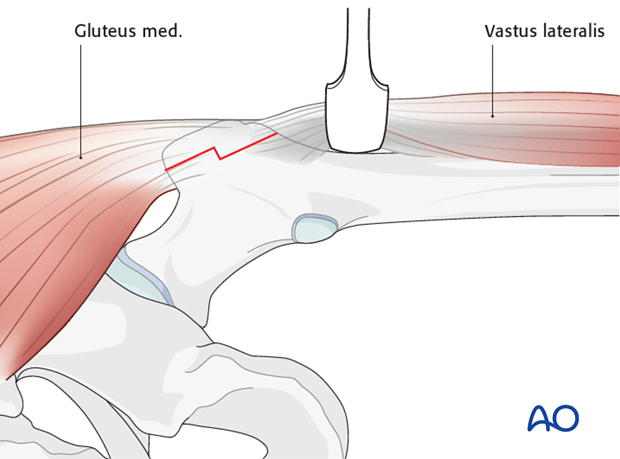 lateral approach via trochanteric flip