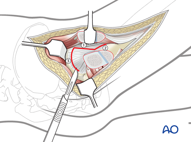 lateral approach via trochanteric flip