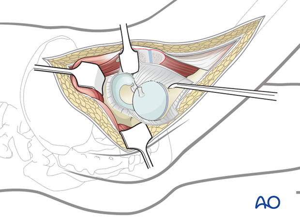 surgical hip dislocation