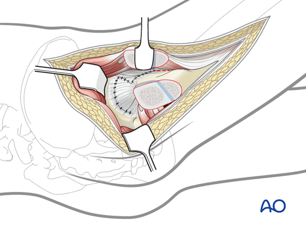 lateral approach via trochanteric flip