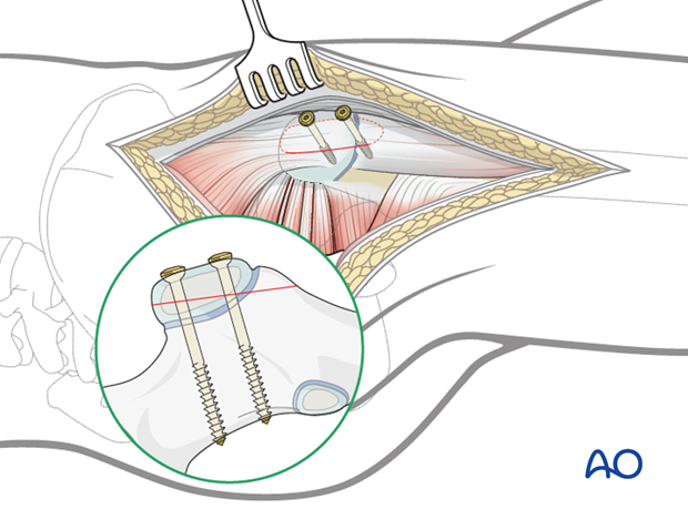 lateral approach via trochanteric flip