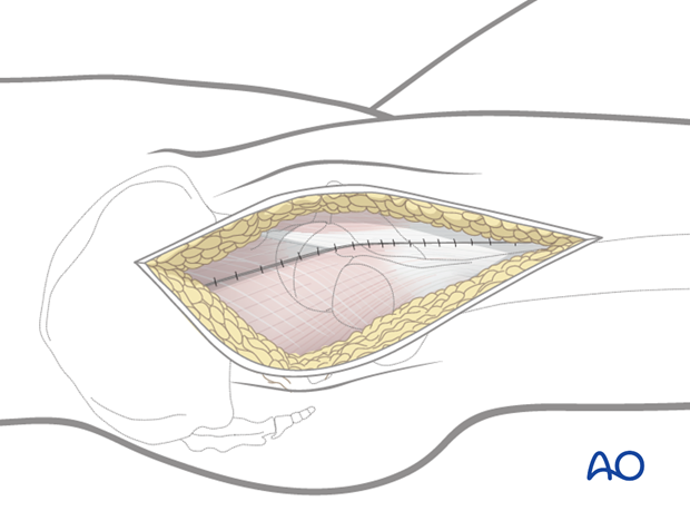 lateral approach via trochanteric flip