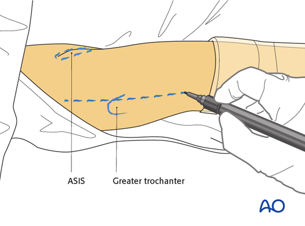 lateral approach via trochanteric flip