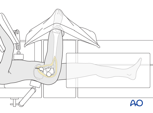 surgical hip dislocation