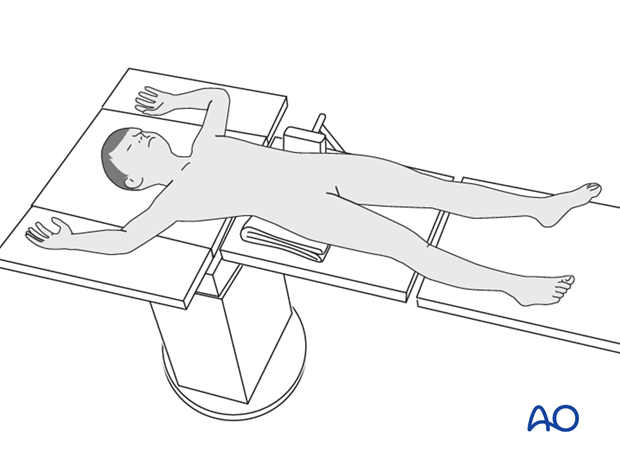 in situ fixation with k wires or screws