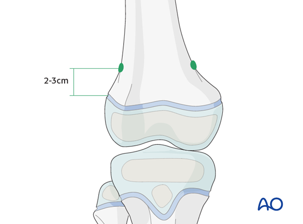 Position of nail entry points