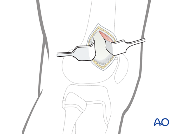 Exposure of the cortex of the femur