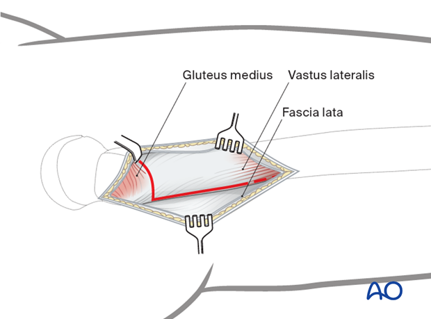 Extraperiosteal L-shape incision for femoral shaft exposure