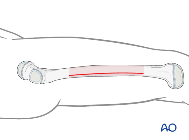 Line for short incisions along the lateral femoral shaft