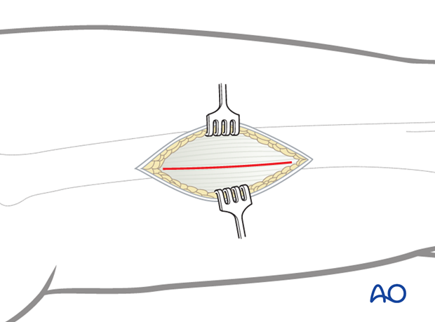 Incision of the fascia lata