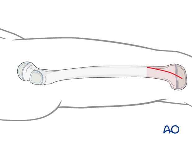 Minimally invasive osteosynthesis approach