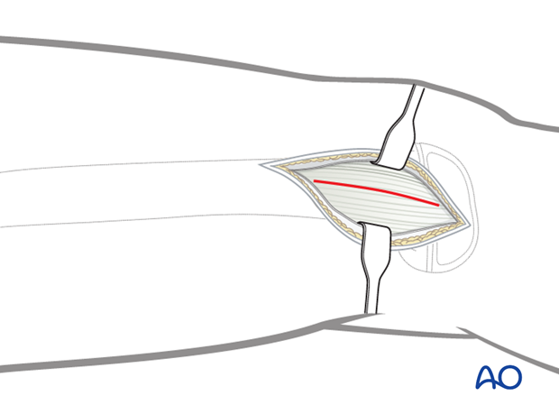 Incision of the fascia lata