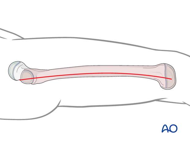 Skin incision line for lateral approach