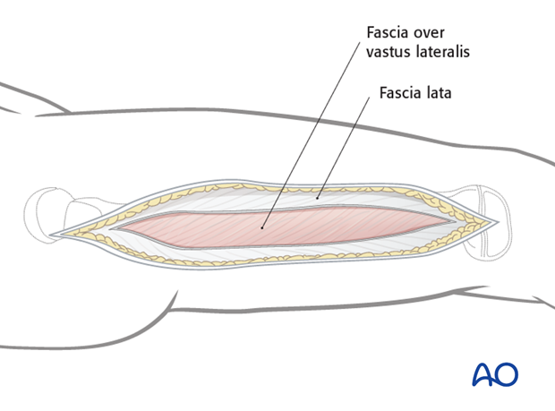 Opening the fascia lata