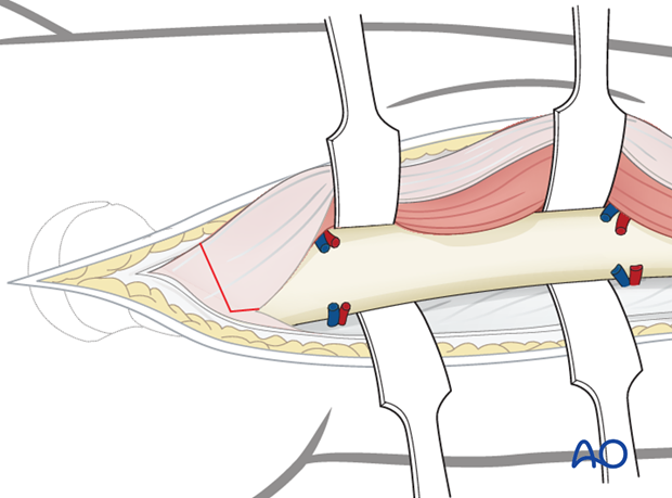 Exposure of the proximal femoral shaft