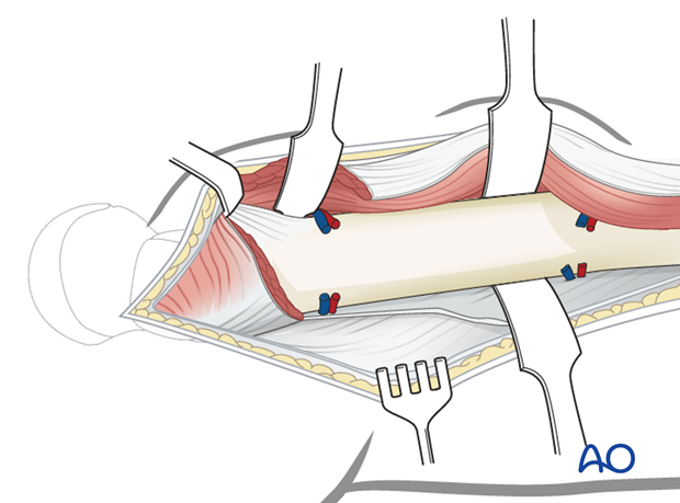 Detachment of vastus lateralis