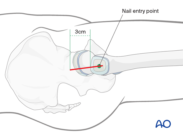 Entry point for lateral-entry intramedullary nailing