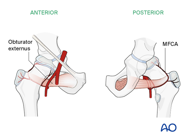 Deep branch of the medial femoral circumflex artery (MFCA)