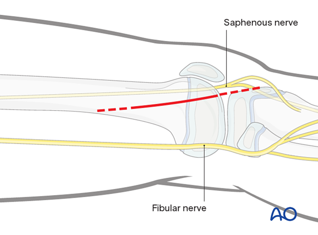 Skin incision for lateral approach to the distal femur