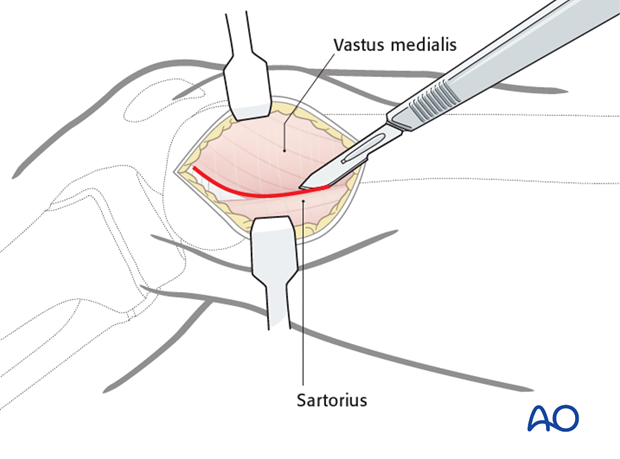 Deep dissection for physeal fractures